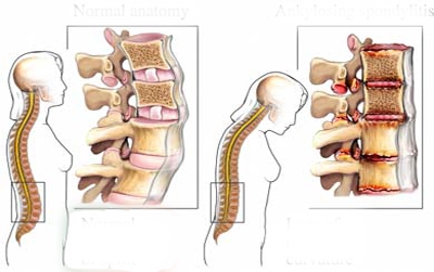 Giúp bạn Viêm cột sống dính khớp: Bệnh dễ gây tàn phế