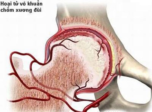 Giúp bạn Viêm khớp nhiễm khuẩn