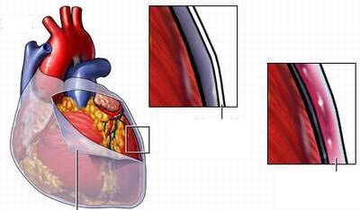 Giúp bạn Viêm màng ngoài tim: Nguyên nhân và triệu chứng