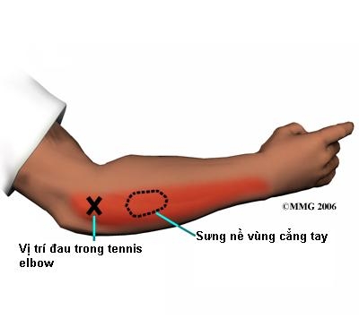 Giúp bạn Viêm mỏm trên lồi cầu xương cánh tay