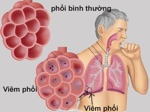 Giúp bạn Viêm phổi do virus