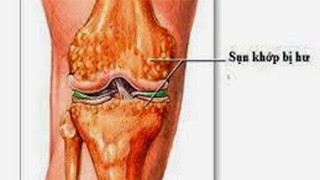 Giúp bạn Vôi hóa sụn khớp