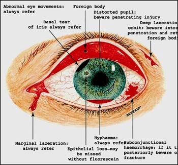 Giúp bạn Xuất huyết dưới kết mạc